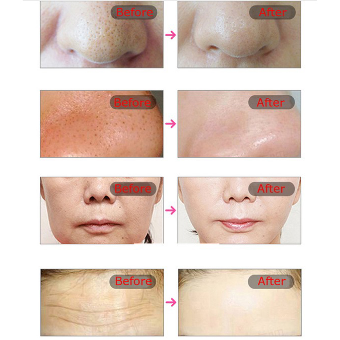 LED Μάσκα Προσώπου για Φωτοθεραπεία - New Light Therapy Mask